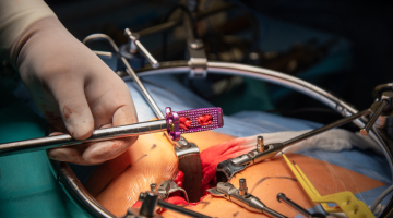 Olomoucký meziobratlový implantát již pomohl stovce pacientů