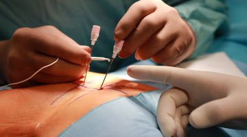 Potíže se střevní inkontinencí může vyřešit neurostimulace. Provádí ji i Fakultní nemocnice Olomouc
