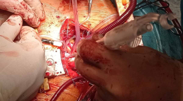 Kardiochirurgové FN Olomouc využívají k náhradě aortální chlopně bezstehové bioprotézy