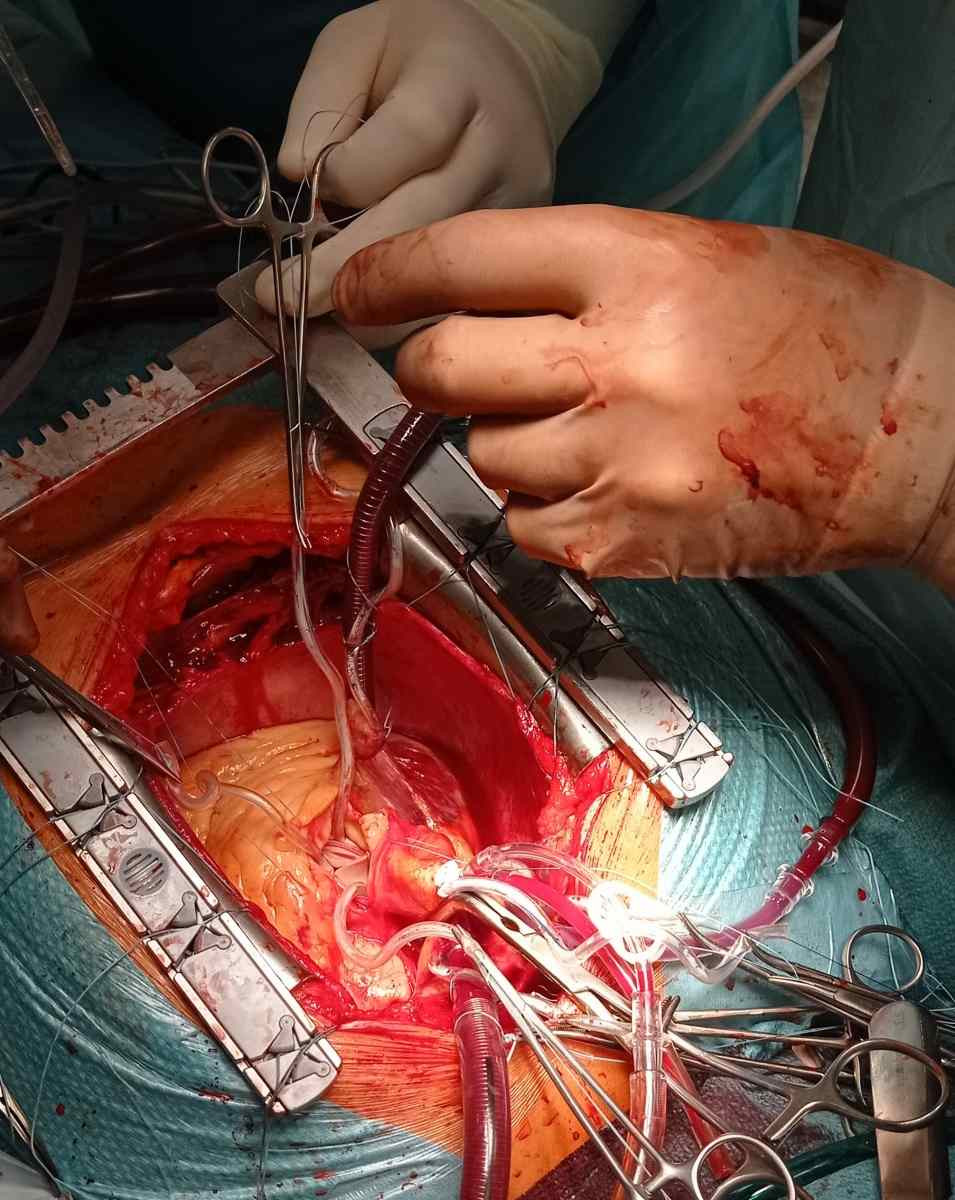 Náhrada aortální chlopně ze střední sternotomie