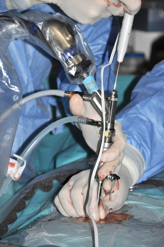 Zavedený endoskop během operace