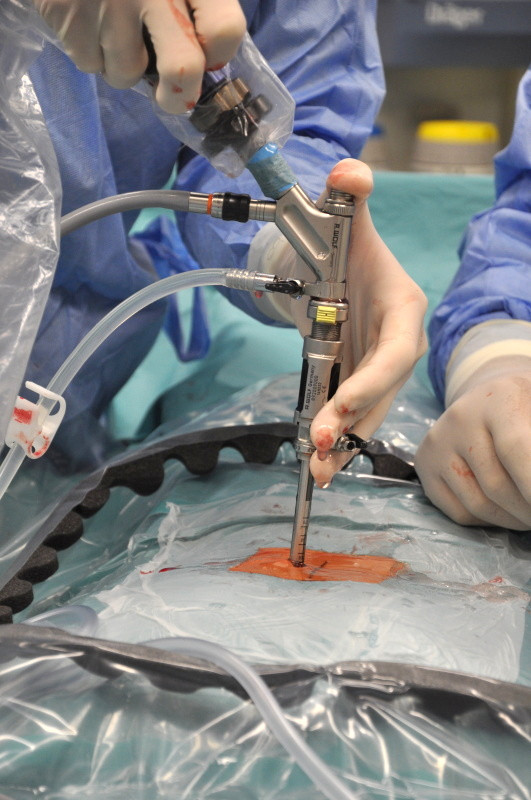 Zavedený endoskop během operace